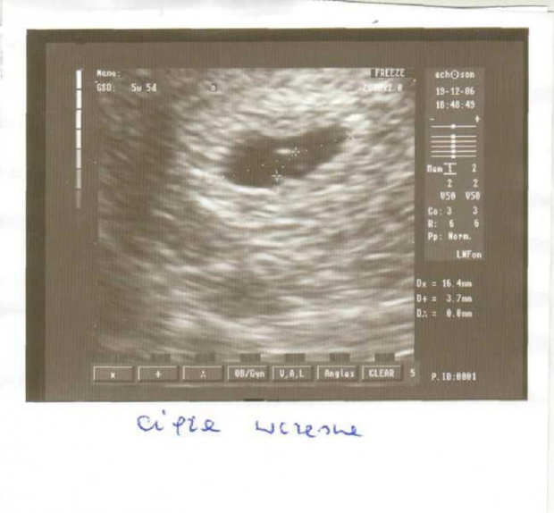 Wg om 5w3d
Pęcherzyk ciążowy ma 16,4mm
Pęcherzyk żółtkowy ma 3,7mmm